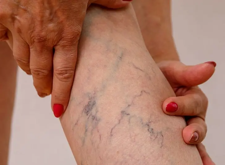 When to worry about varicose veins?
