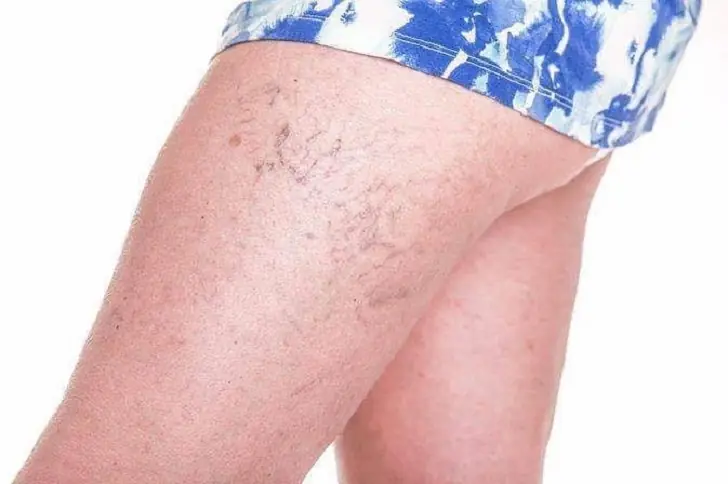 When to worry about varicose veins?