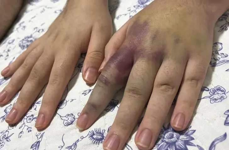 Hematoma vs bruise: Key differences.