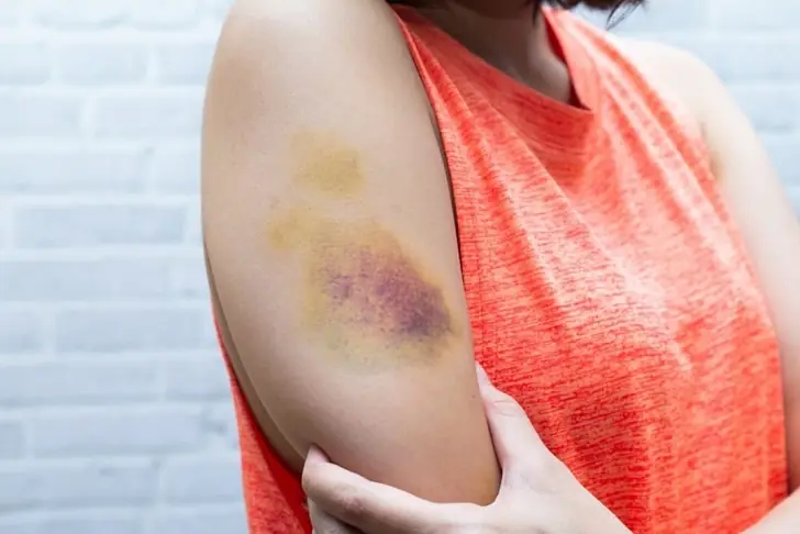 Hematoma vs bruise: Key differences.